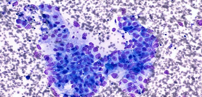 El estudio de un gen abre una nueva puerta a la prevención del cáncer de páncreas