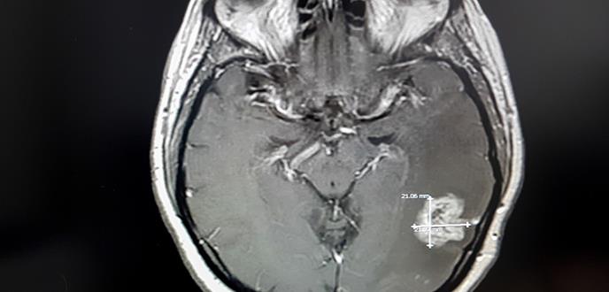 Avances para conseguir una terapia efectiva contra el tumor cerebral más frecuente