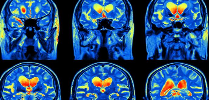 Una inmunoterapia a partir del virus del resfriado modificado consigue frenar el cáncer cerebral más letal