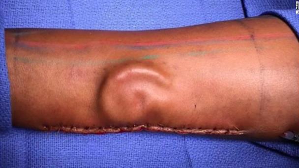 Una soldado perdió su oreja en un accidente y los médicos le crearon otra en el antebrazo Una soldado perdió su oreja en un accidente y los médicos le crearon otra en el antebrazo