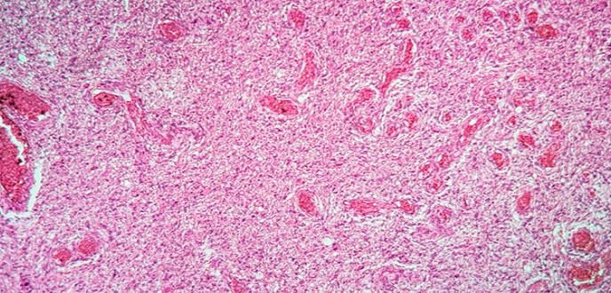 La biopsia líquida en líquido cefalorraquídeo permite mejorar el diagnóstico de los gliomas