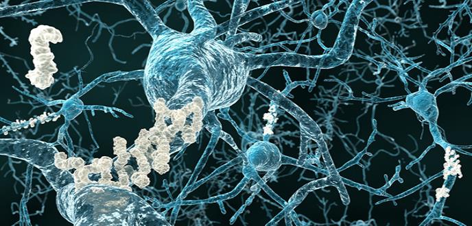 Detectan alteraciones en la estructura cerebral de personas sanas con un mayor riesgo de desarrollar alzhéimer