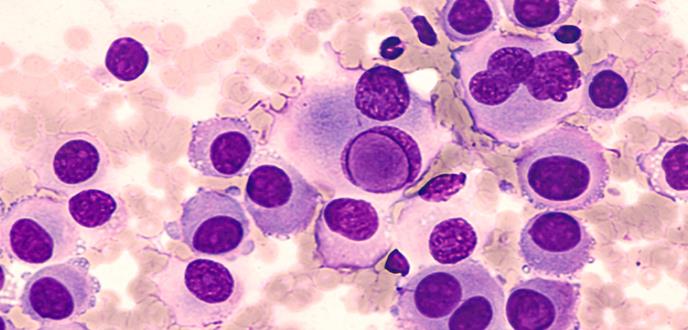 Melanoma rectal causa revés clínico en Puerto Rico