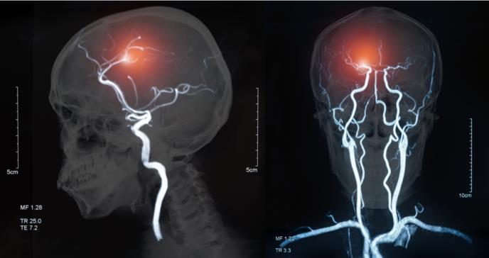 Nueva herramienta gratuita para predecir accidentes cerebrovasculares