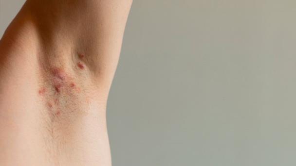 Actualización en hidradenitis supurativa: aspectos terapéuticos Actualización en hidradenitis supurativa: aspectos terapéuticos