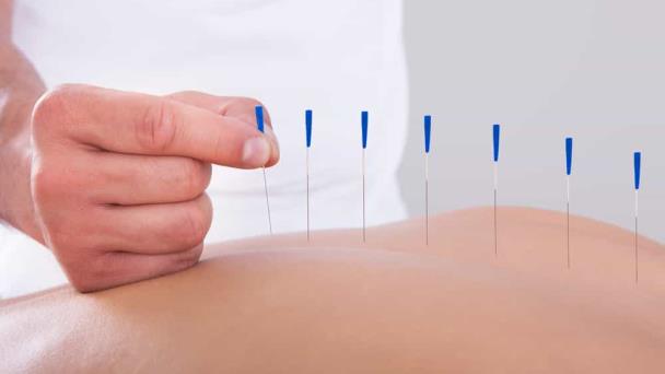Acupuntura, más que una medicina alternativa