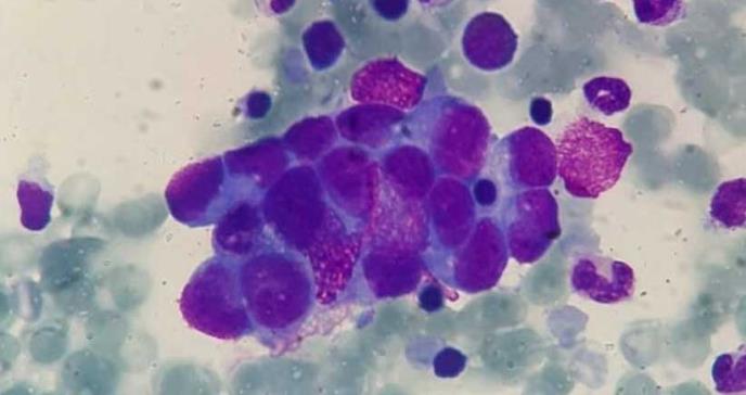 Algoritmo inteligente encuentra posible tratamiento para cáncer infantil