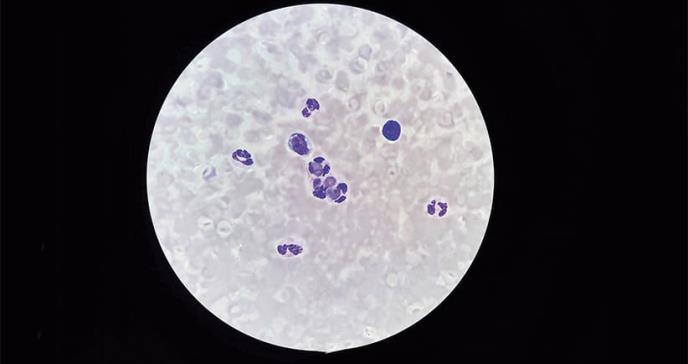 COVID-19 y los Medicamentos para tratar el Lupus