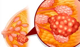 5 pasos para el autoexamen de mamas