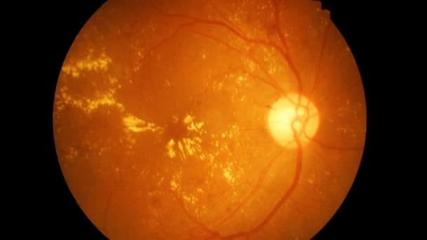 Bebidas para diabéticos asociadas con enfermedad ocular