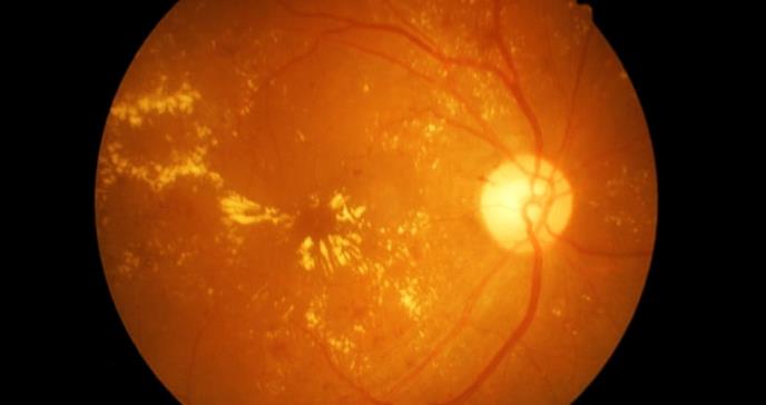 Bebidas para diabéticos asociadas con enfermedad ocular