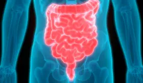 Biosimilar, un medicamento para tratar pacientes con enfermedad de Crohn y Colitis Ulcerosa