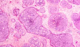 Verzenio® Significantly Reduced the Risk of Cancer Recurrence by 25% for People with HR+, HER2- High Risk Early Breast Cancer