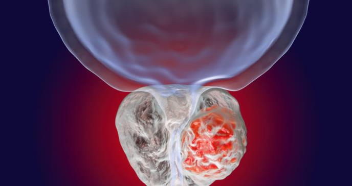 Estudio muestra la eficacia del primer tratamiento personalizado para el cáncer de próstata avanzado