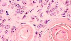 Cáncer de pulmón de células pequeñas: el padecimiento más común en los órganos