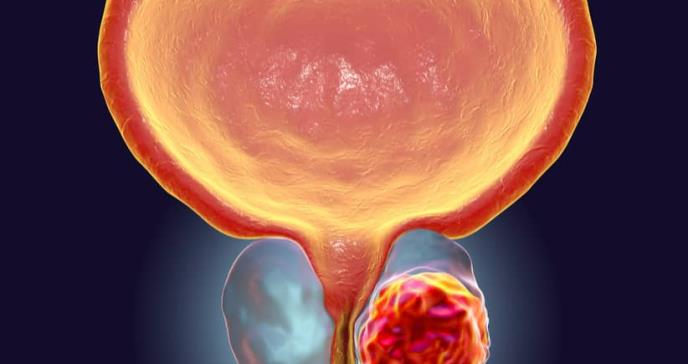 La circuncisión podría proteger frente al cáncer de próstata