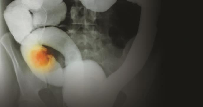 Cáncer Colorrectal en Puerto Rico: Epidemiología, Herencia y Genética Molecular
