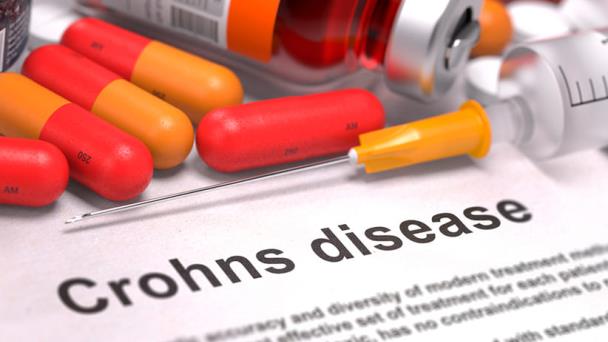 Cómo tratar la condición de Crohn Cómo tratar la condición de Crohn