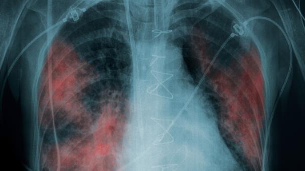 COVID-19: El grave daño que puede causar el virus a pacientes asintomáticos COVID-19: El grave daño que puede causar el virus a pacientes asintomáticos
