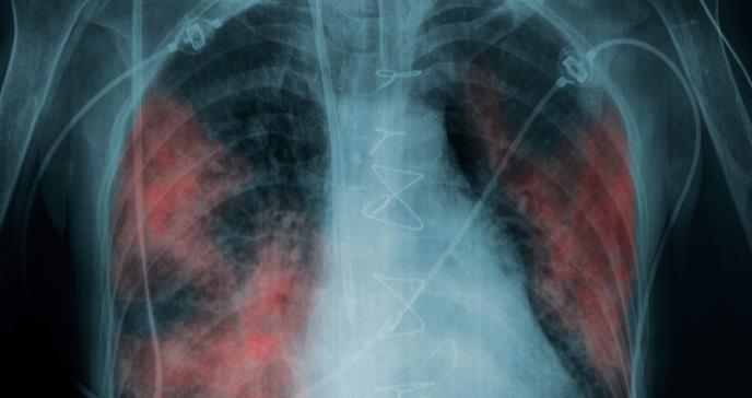 COVID-19: El grave daño que puede causar el virus a pacientes asintomáticos