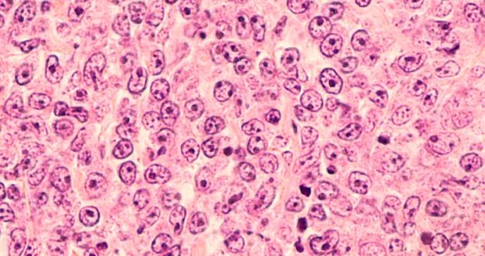 Descifran el perfil molecular de tres subtipos de linfoma de células B grandes