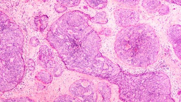 Describen la implicación de la glucosa en el crecimiento de células tumorales