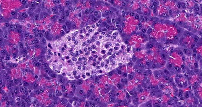 Descubren cómo mejorar los trasplantes para tratar la diabetes tipo 1