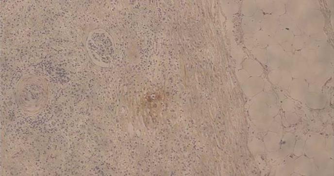 Descubren un mecanismo que interviene en los procesos de expansión del carcinoma renal