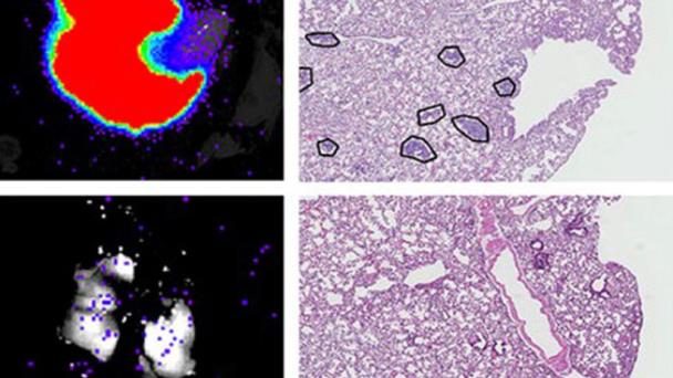 Descubren una proteína que desencadena la metástasis tumoral