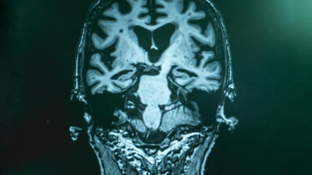 Nueva terapia podría evitar el deterioro cognitivo en adultos mayores