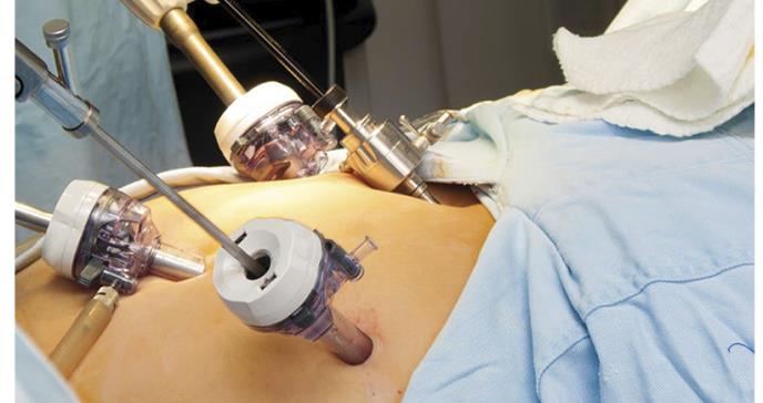 Efectos metabólicos presentes un año luego de Roux NY gastric bypass o Sleeve Gastrectomy como CIRUGÍA BARIÁTRICA para reducción de peso