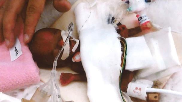 El “bebé más chiquito del mundo”, a punto de dejar el hospital El “bebé más chiquito del mundo”, a punto de dejar el hospital