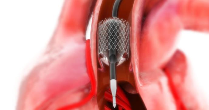 El bypass incrementa su efectividad en pacientes con problemas cardiovasculares