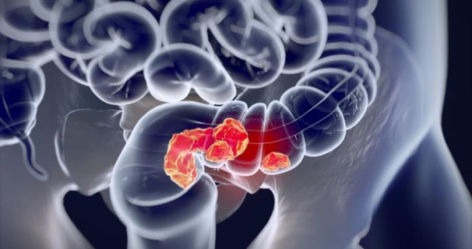 El cáncer colorrectal con inicio a edades tempranas es distinto al de los pacientes mayores
