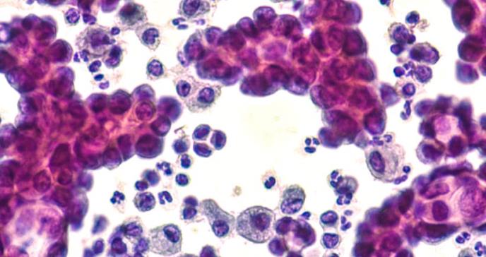 El cáncer de pulmón aumenta en no fumadores por el efecto de la polución y el tabaquismo pasivo