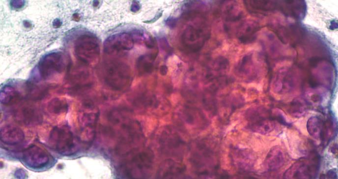 El cáncer de pulmón será la primera causa de muerte en mujeres