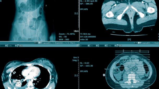El cáncer también produce daños severos en el corazón El cáncer también produce daños severos en el corazón