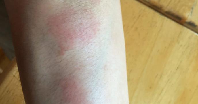 El Lupus Eritematoso Sistémico tiene mayor prevalencia en las mujeres
