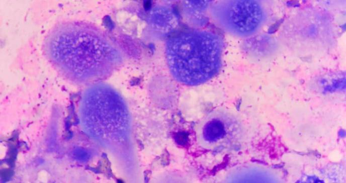 El sistema inmune exhibe sus armas contra el cáncer