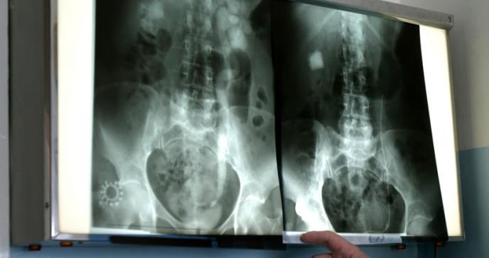 Tratamiento personalizado: método más eficaz para tratar cáncer de riñón