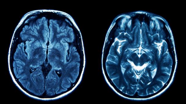 En qué se diferencian el alzhéimer y la demencia En qué se diferencian el alzhéimer y la demencia