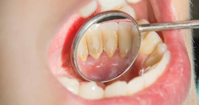 Enfermedades bucales: un riesgo para pacientes con hemofilia
