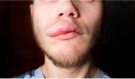 Buscan el tratamiento del angioedema hereditario en Puerto Rico