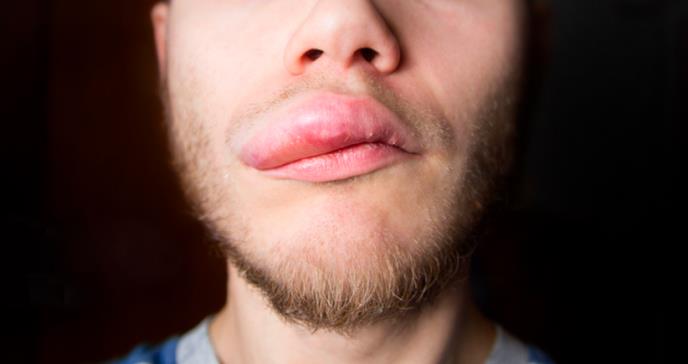 Buscan el tratamiento del angioedema hereditario en Puerto Rico