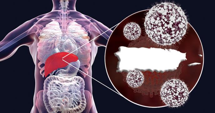 Erradicación de la hepatitis C en Puerto Rico