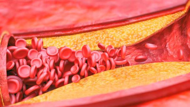 Fabrican nanopartículas que eliminan la placa que obstruye las arterias Fabrican nanopartículas que eliminan la placa que obstruye las arterias