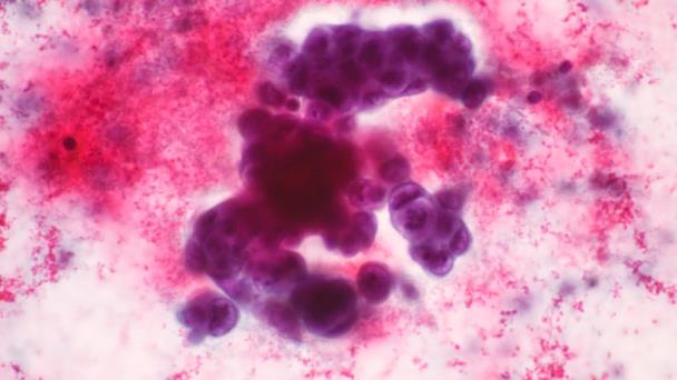 Fármacos de bajo uso detienen la metástasis del cáncer de seno Fármacos de bajo uso detienen la metástasis del cáncer de seno