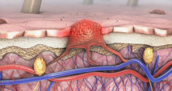 Dosificación intermitente de fármacos no ayudaría a pacientes con melanoma