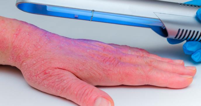 Fototerapia, efectivo tratamiento en pacientes con dermatitis atópica
