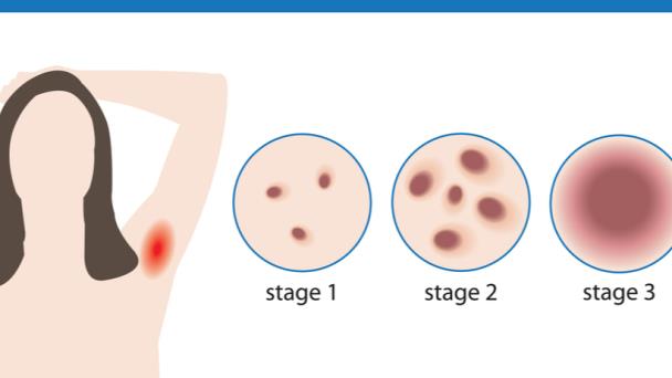 Hidradenitis supurativa y sus aspectos terapéuticos Hidradenitis supurativa y sus aspectos terapéuticos